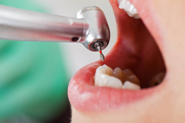 Best Emergency Tooth Extraction in Meadowbrook, CA